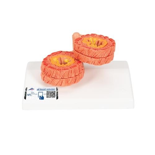 COPD Bronkial Vävnadsmodell