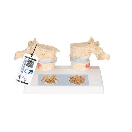 Osteoporos didaktisk modell