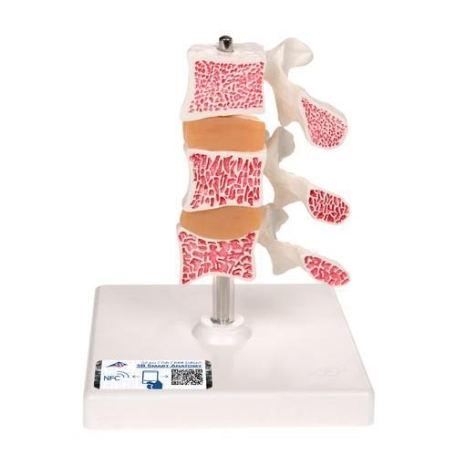 Deluxe mänsklig osteoporosmodell (3 ryggkotor med skivor), avtagbar på stativ
