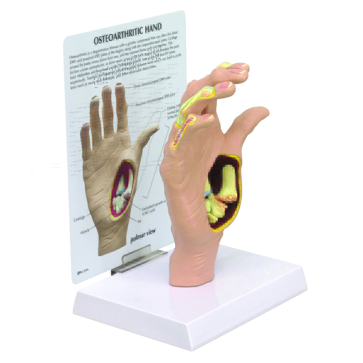 Handmodell för osteoartrit