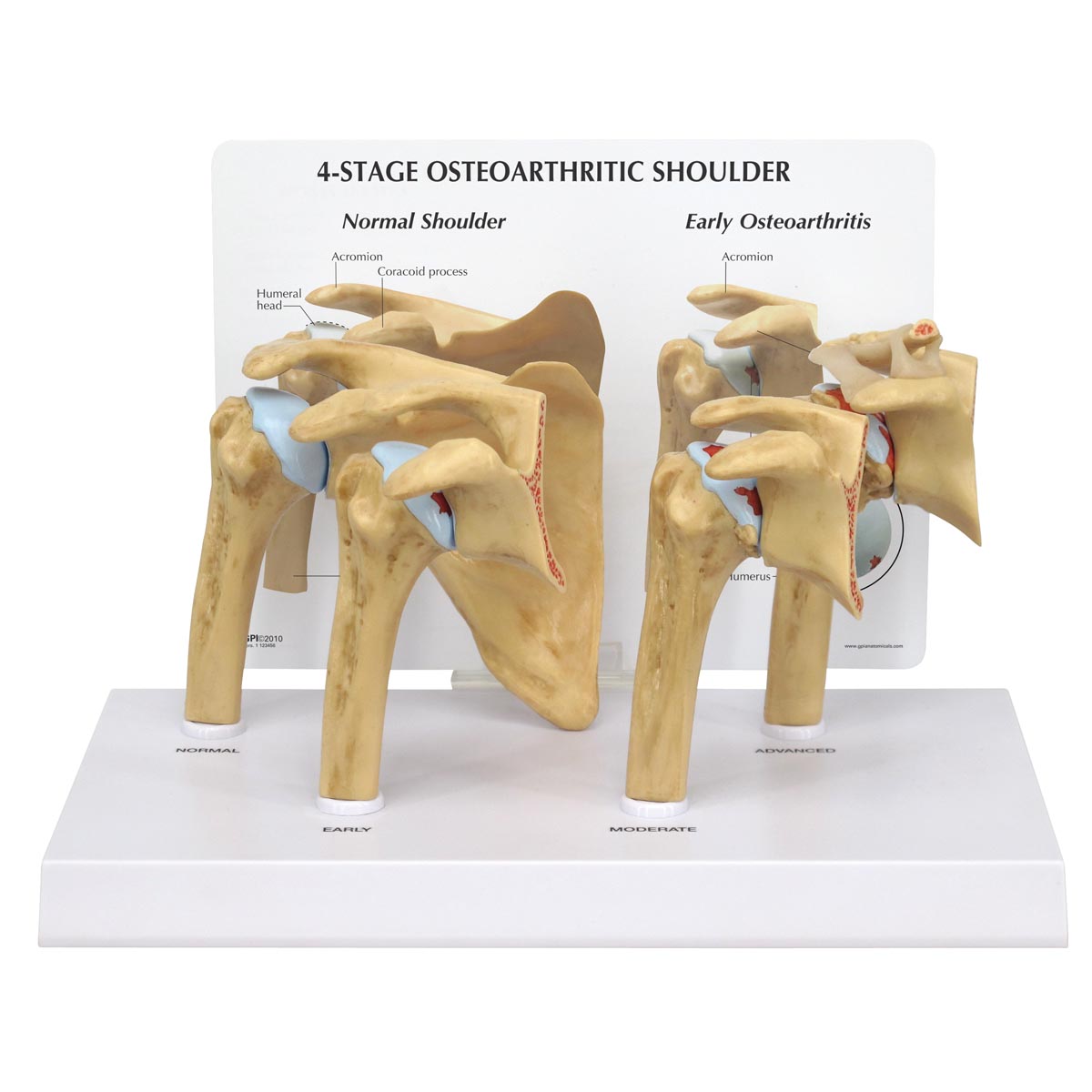 Modell för 4-stegs osteoartrit (OA) i axeln