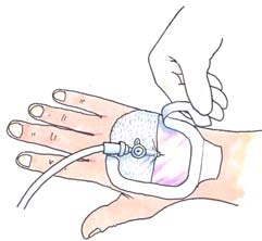 Mepore IV Dressing