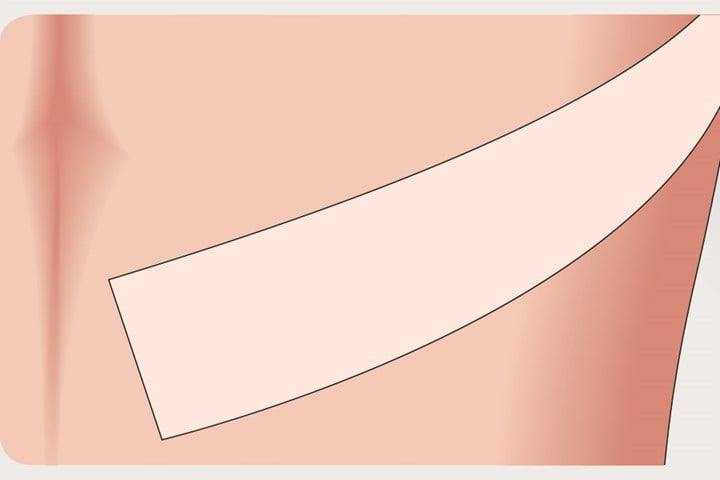 Mepiform Scar Treatment Dressing
