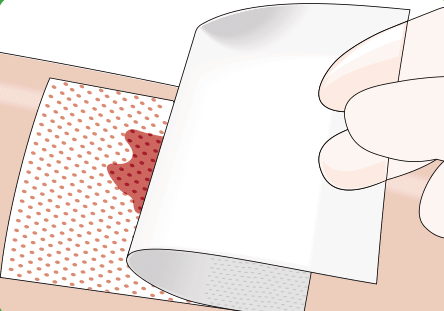 Mepitel Silicone Wound Contact Layer